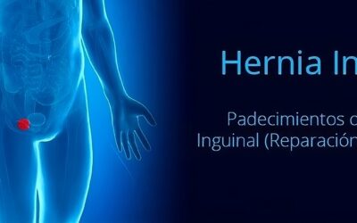 Cirugía de hernia inguinal