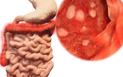 Síndrome del Intestino Irritable: Entendiendo y Manejando tus Síntomas