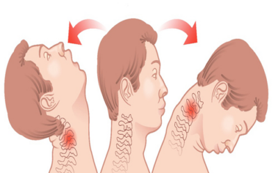 Latigazo cervical: la importancia de un buen tratamiento