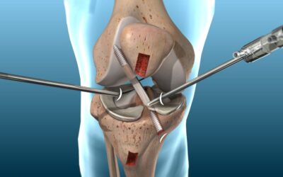 Consejos y ejercicios para después de una atroscopia de rodilla